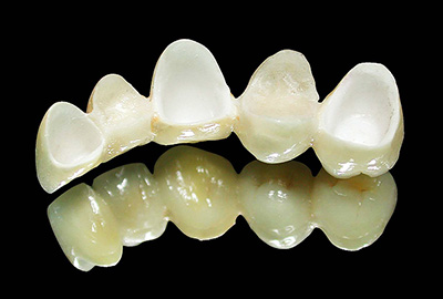  - All-ceramic zirconia